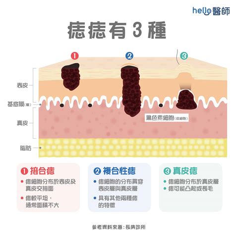 陰莖 痣